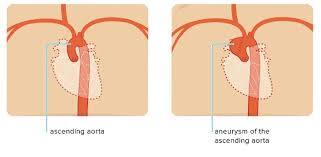 Redo cardiac surgery