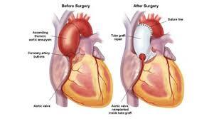 Valve replacement and repair surgeries