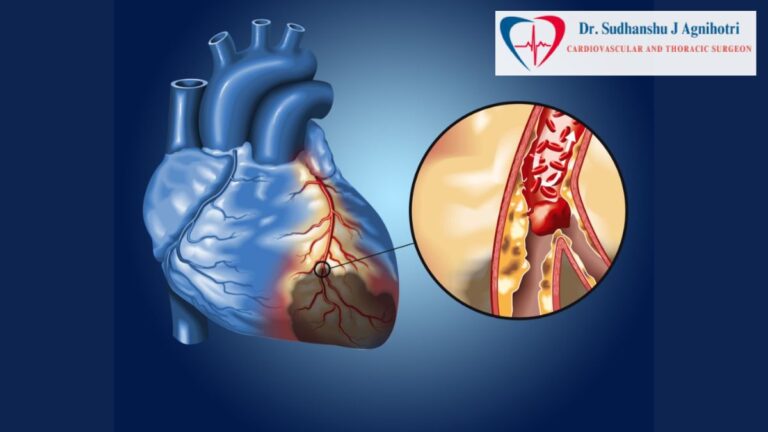 How Do Coronary Arteries Affect Heart Health? Insights from the Best Heart Doctor in Indore