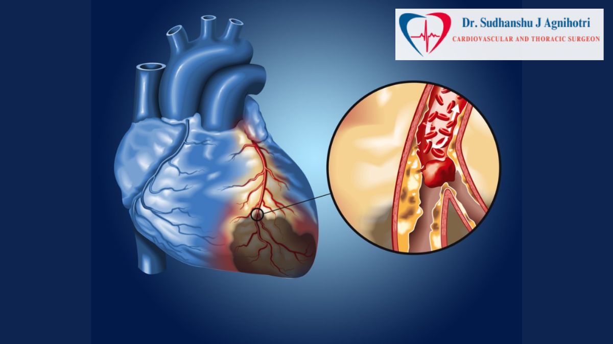 Coronary Arteries Dr Sudhanshu J Agnihotri Best Heart Doctor in Indore