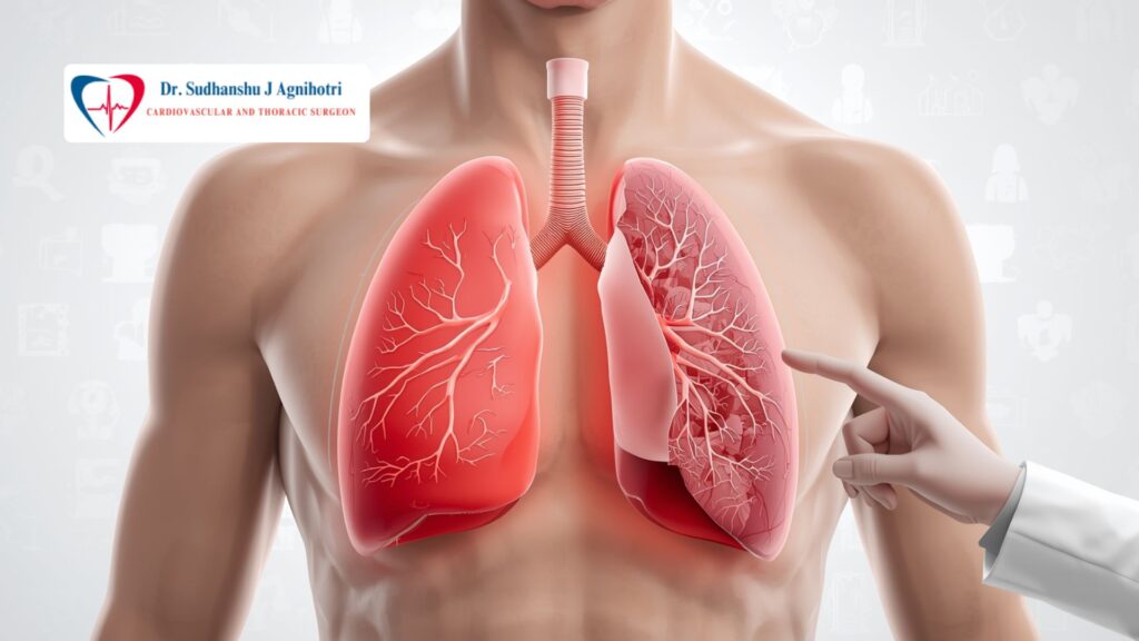 How Much Does Lung Surgery Cost in India