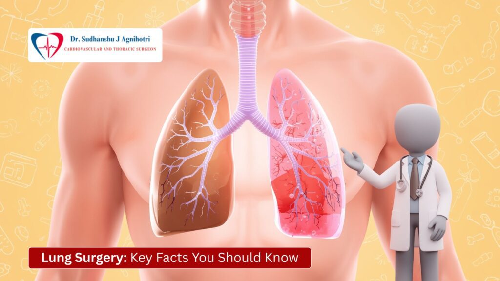 Lung Surgery Key Facts You Should Know - Dr. Sudhanshu Cardiothoracic Surgeon in Indore
