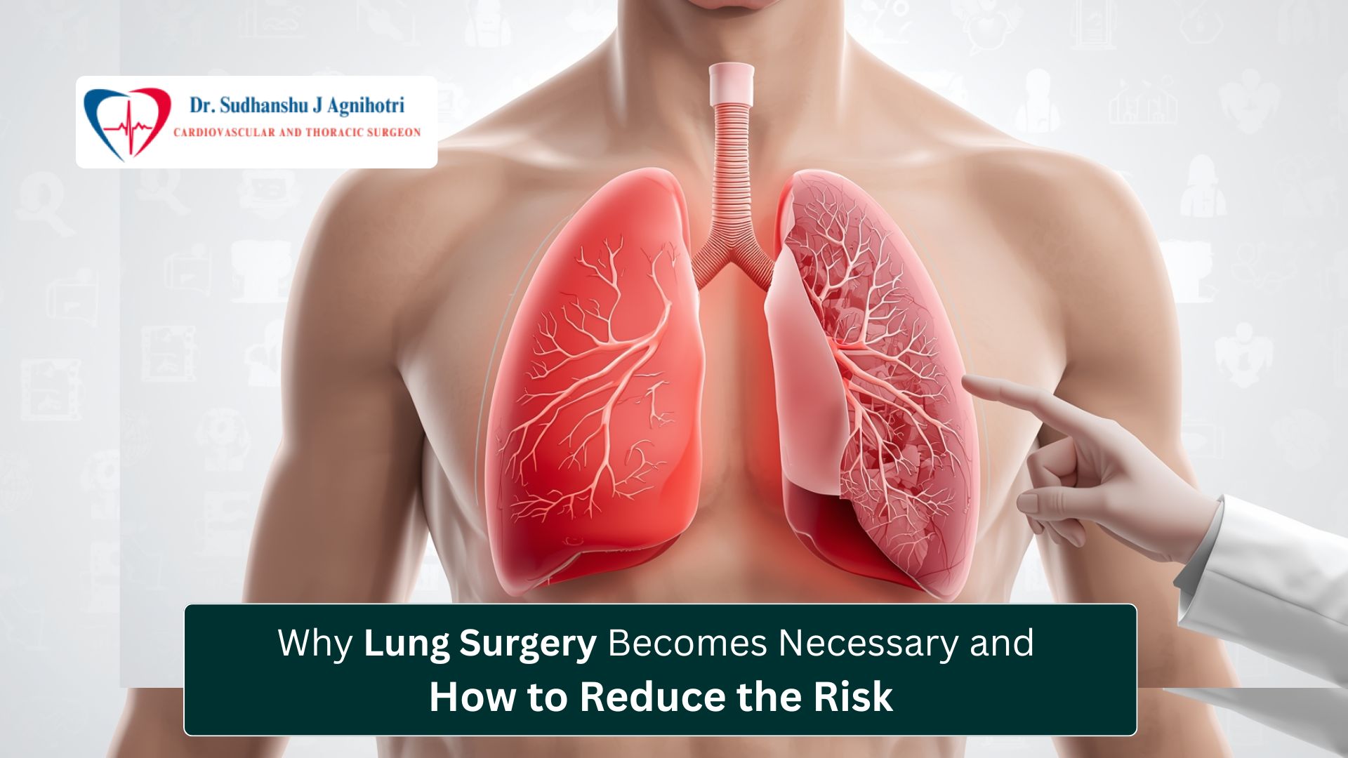 Understanding Lung Surgery Causes, Risks, and Prevention - Dr. Sudhanshu Cardiothoracic Surgeon