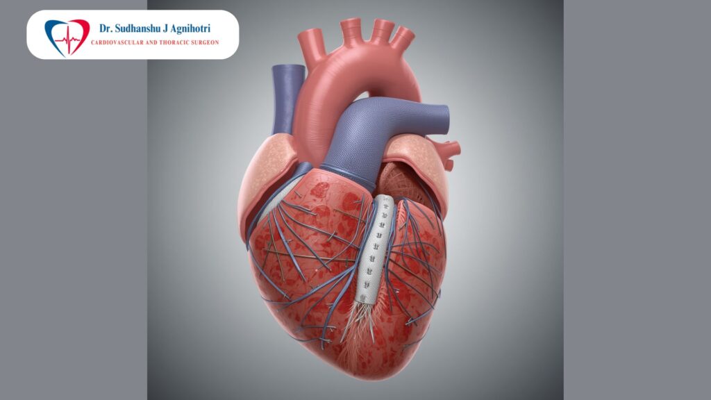 बेंटल सर्जरी की सफलता दर क्या है - Indore best cardiac surgeon dr sudhanshu
