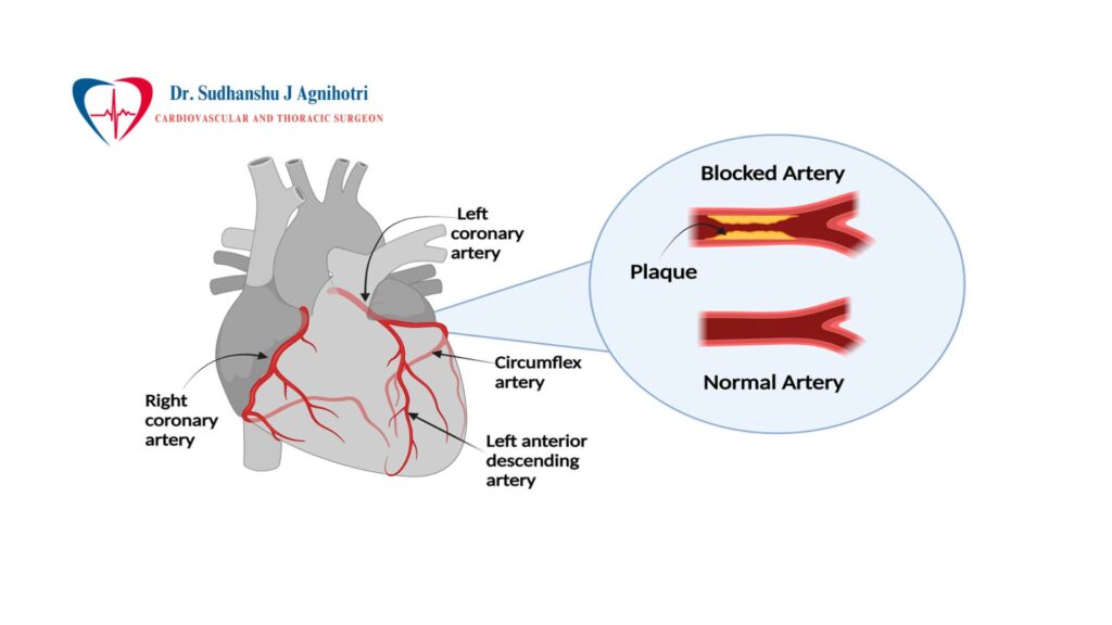 How Does Valvular Stenosis Affect Heart Function?
