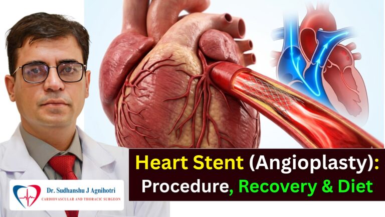 Heart Stent (Angioplasty): Procedure, Recovery, Diet, and Life After Stent